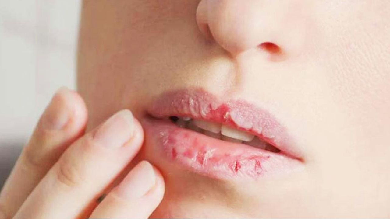 শীতে ঠোঁট ও মুখে ঘা হয় যে কারণে জানুন