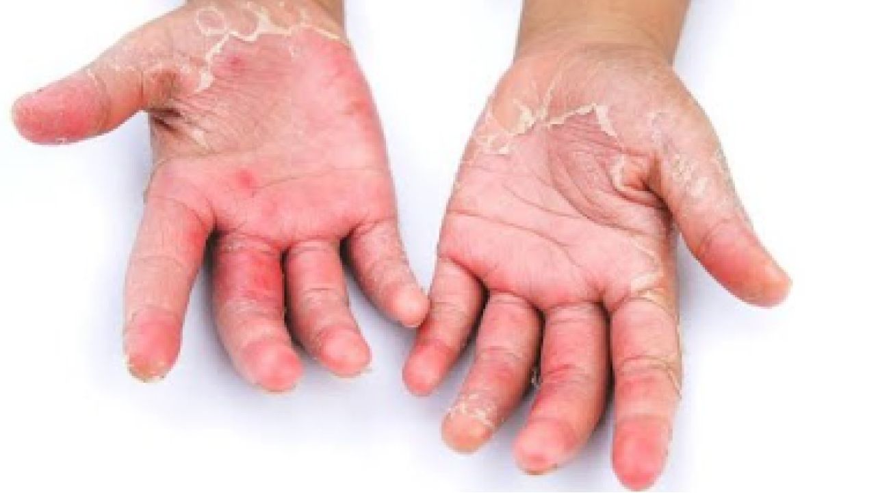 শীতে হাতের চামড়া রক্ষায় যা করবেন