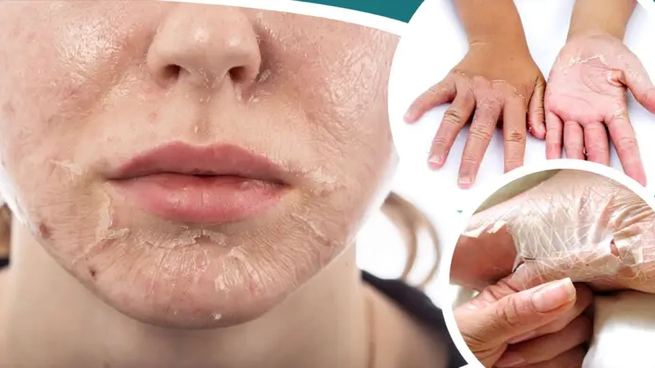 যে কারণে শীত আসতেই গায়ের চামড়া উঠে