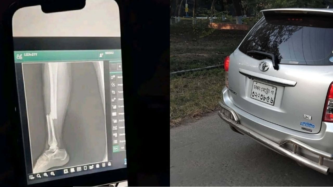 রাবি শিক্ষকের ব্যক্তিগত গাড়ির ধাক্কায় পা ভাঙলো ছাত্রীর